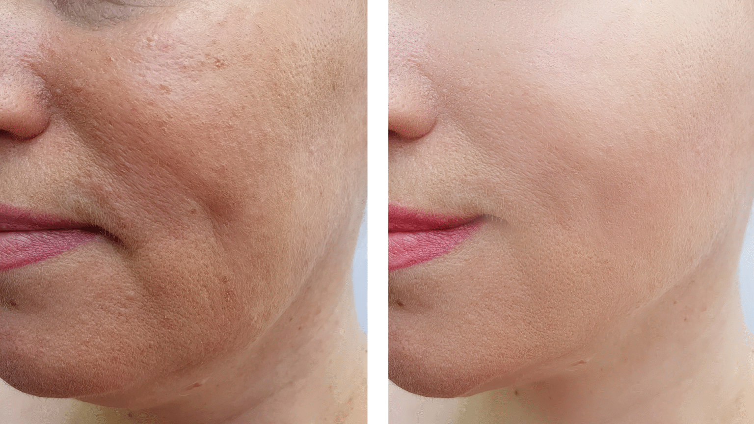 Microneedling vorher nachher Behandlung der Wange durch Lavuebeauty - links vorher und rechts ist nachher.